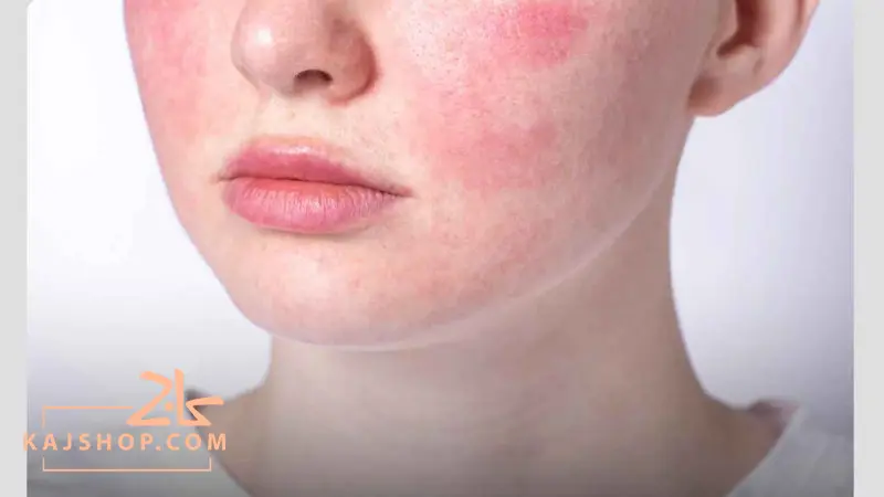 قرمزی صورت بعد از کرم آبرسان
